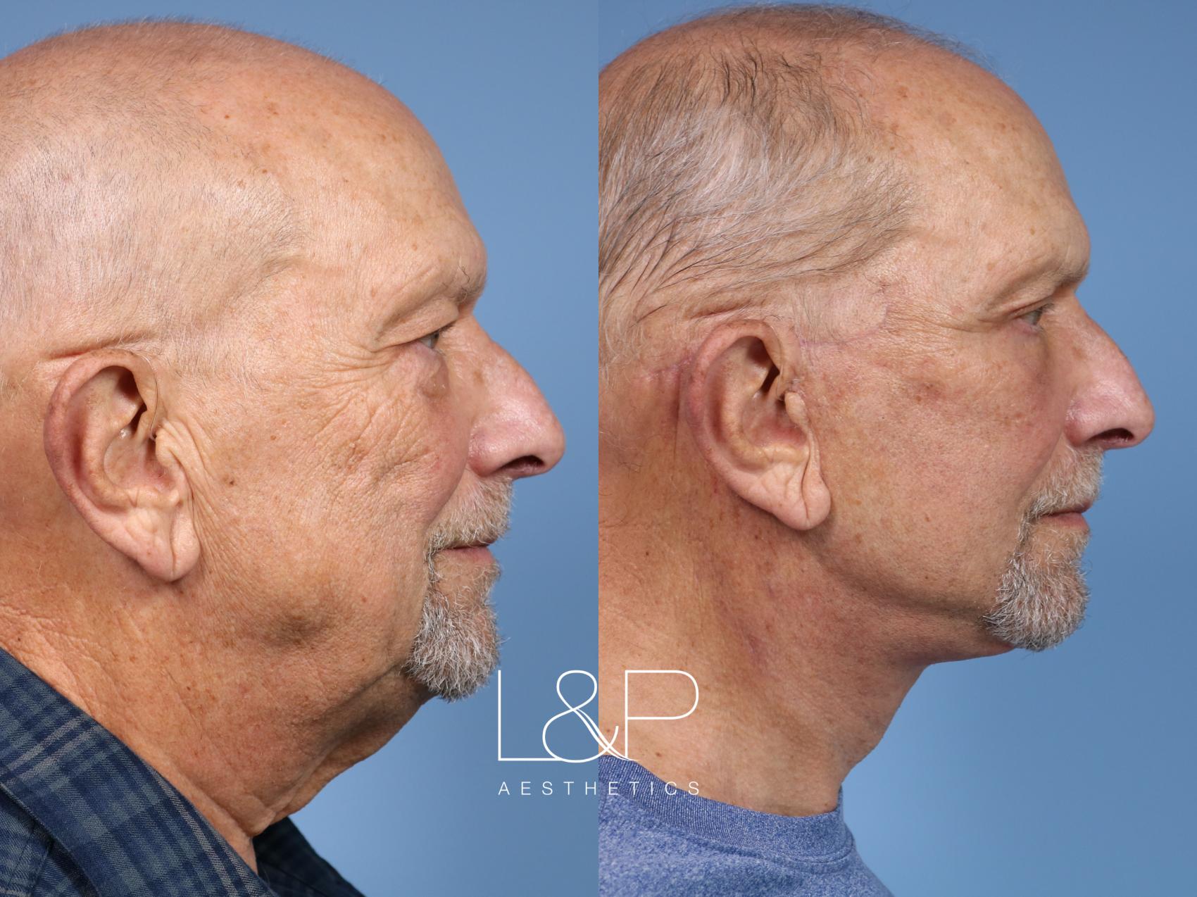 Before & After photos of a Male Facelift