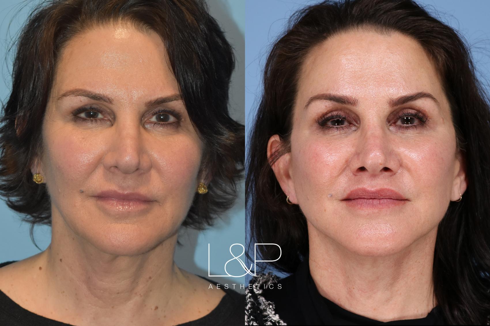 L&P Signature Facelift, Neck Lift, Lip Lift, Brow Lift & Chemical Peel