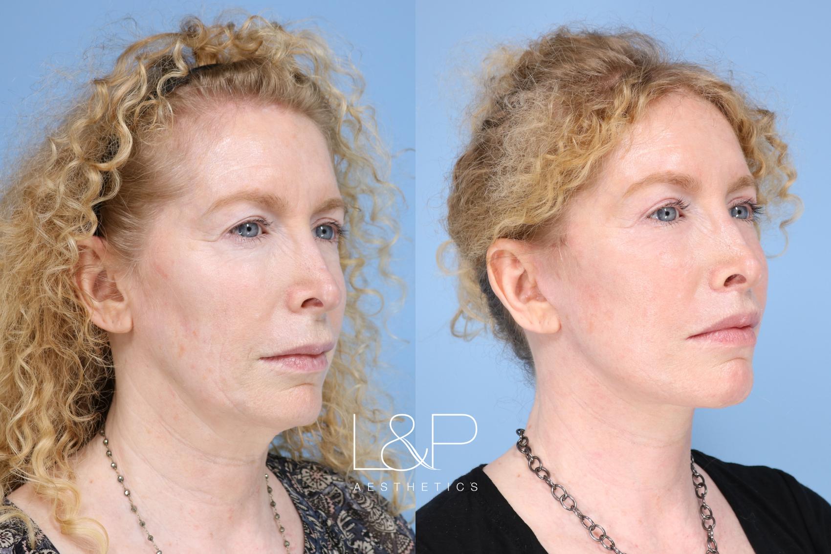Before & After Facelift & Neck Lift Case 154 Right Oblique View in Palo Alto & San Jose, California