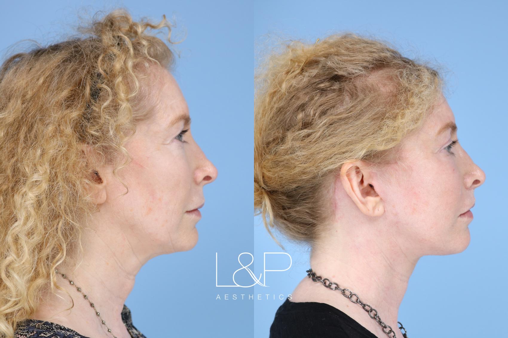 Before & After Facelift & Neck Lift Case 154 Right Side View in Palo Alto & San Jose, California