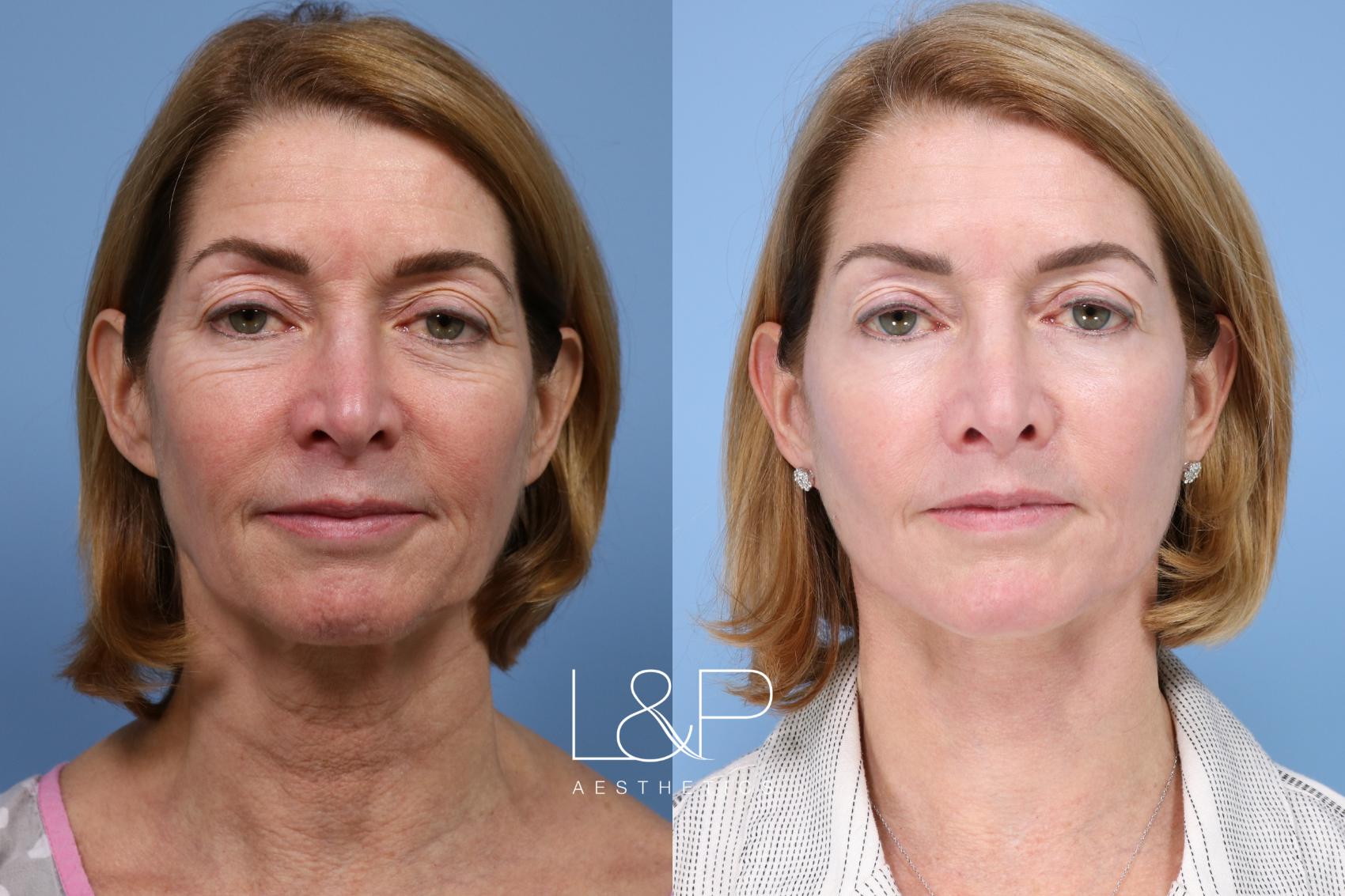 What Is A Laser Facelift at Shirley Ashley blog