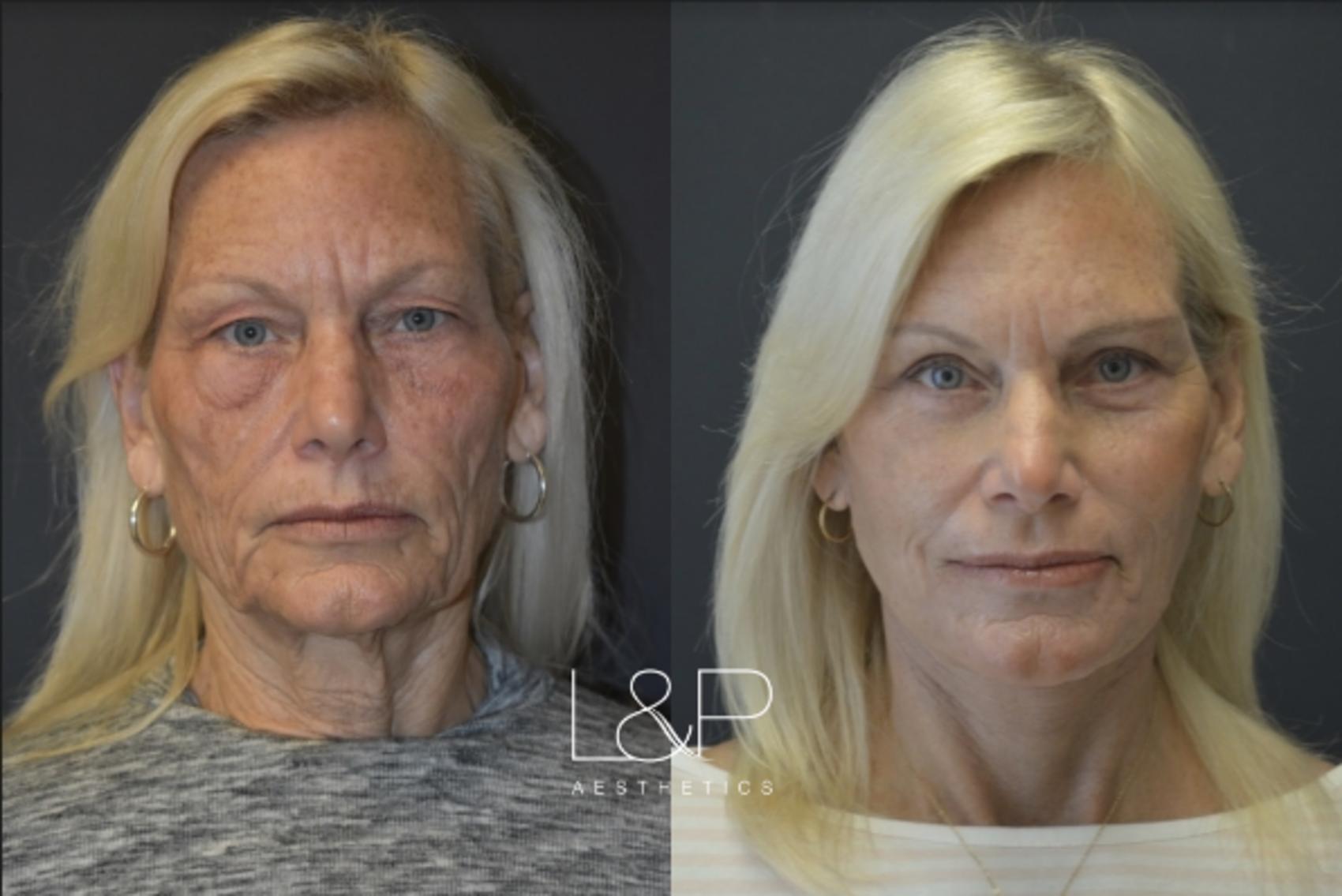 Before & After Laser Resurfacing (TRL) Case 23 Front View in Palo Alto & San Jose, California