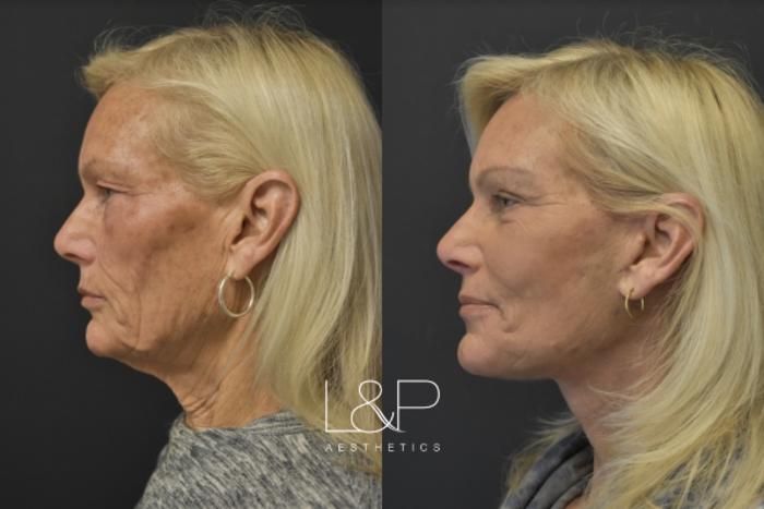 Before & After Facelift & Neck Lift Case 23 Left Side View in Palo Alto & San Jose, California