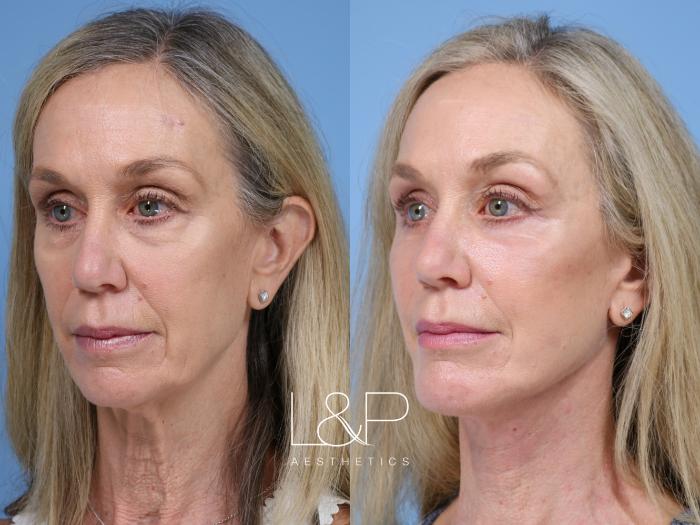 L&P Signature Facelift and Neck Lift for thinner woman 