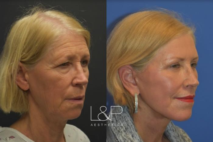 Before & After Facelift & Neck Lift Case 25 Right Oblique View in Palo Alto & San Jose, California