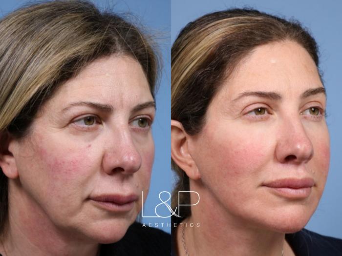 Deep Plane Face & Neck Lift for Facial Rejuvenation