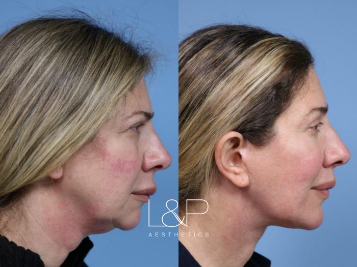 Deep Plane Face & Neck Lift for Facial Rejuvenation