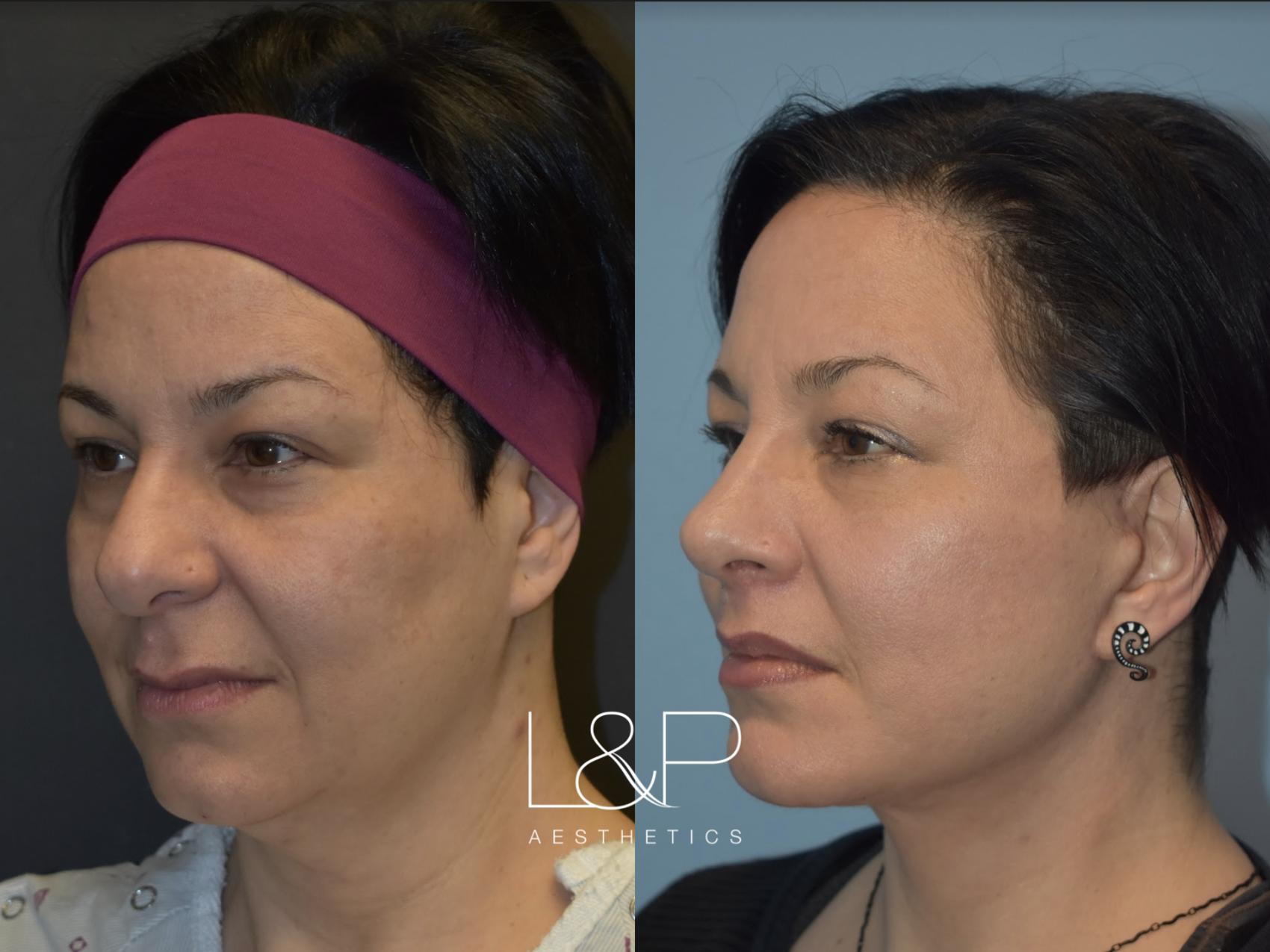 Before & After Facelift & Neck Lift Case 26 Front View in Palo Alto & San Jose, California