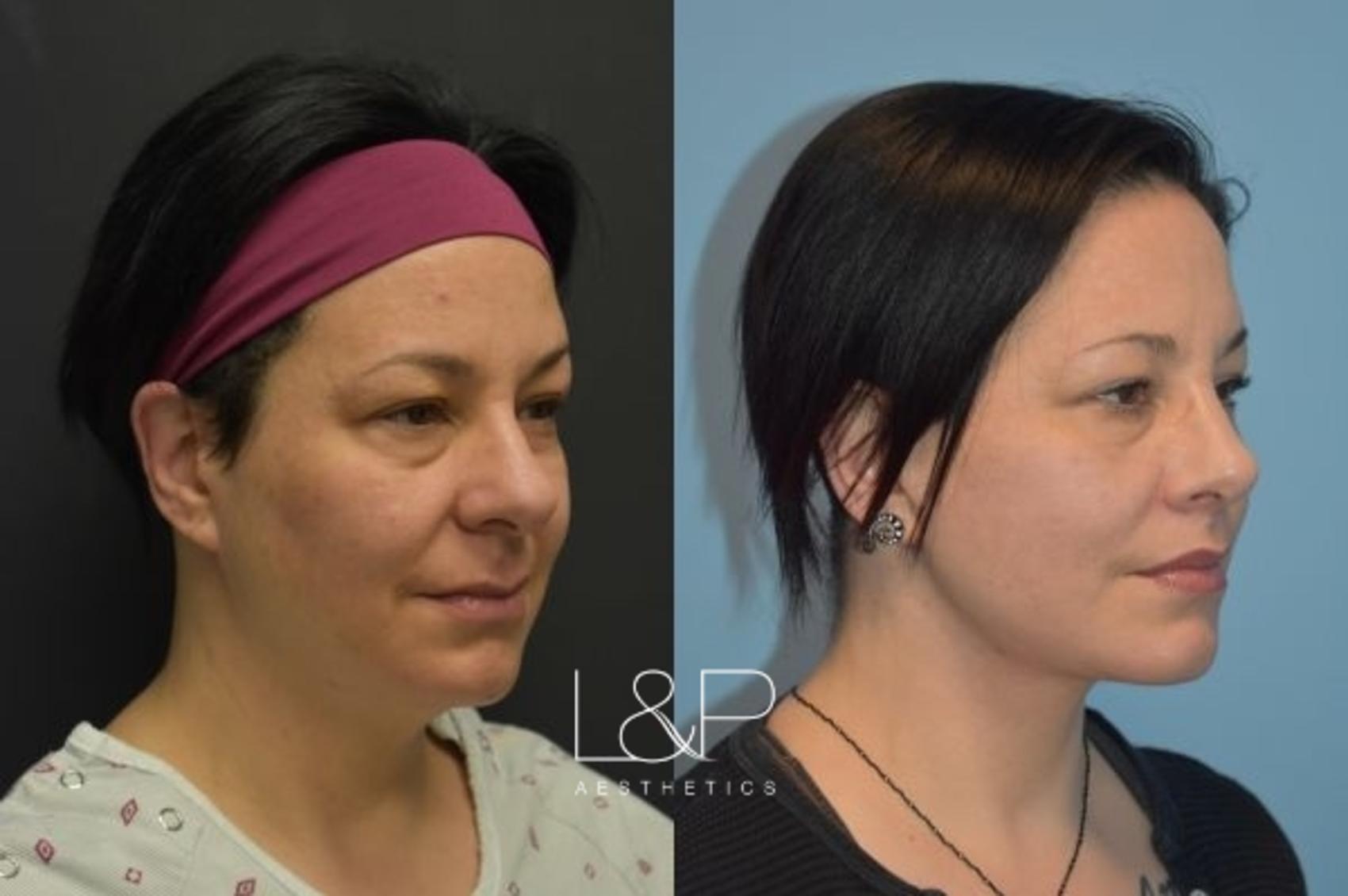 Before & After Facelift & Neck Lift Case 26 Right Oblique View in Palo Alto & San Jose, California