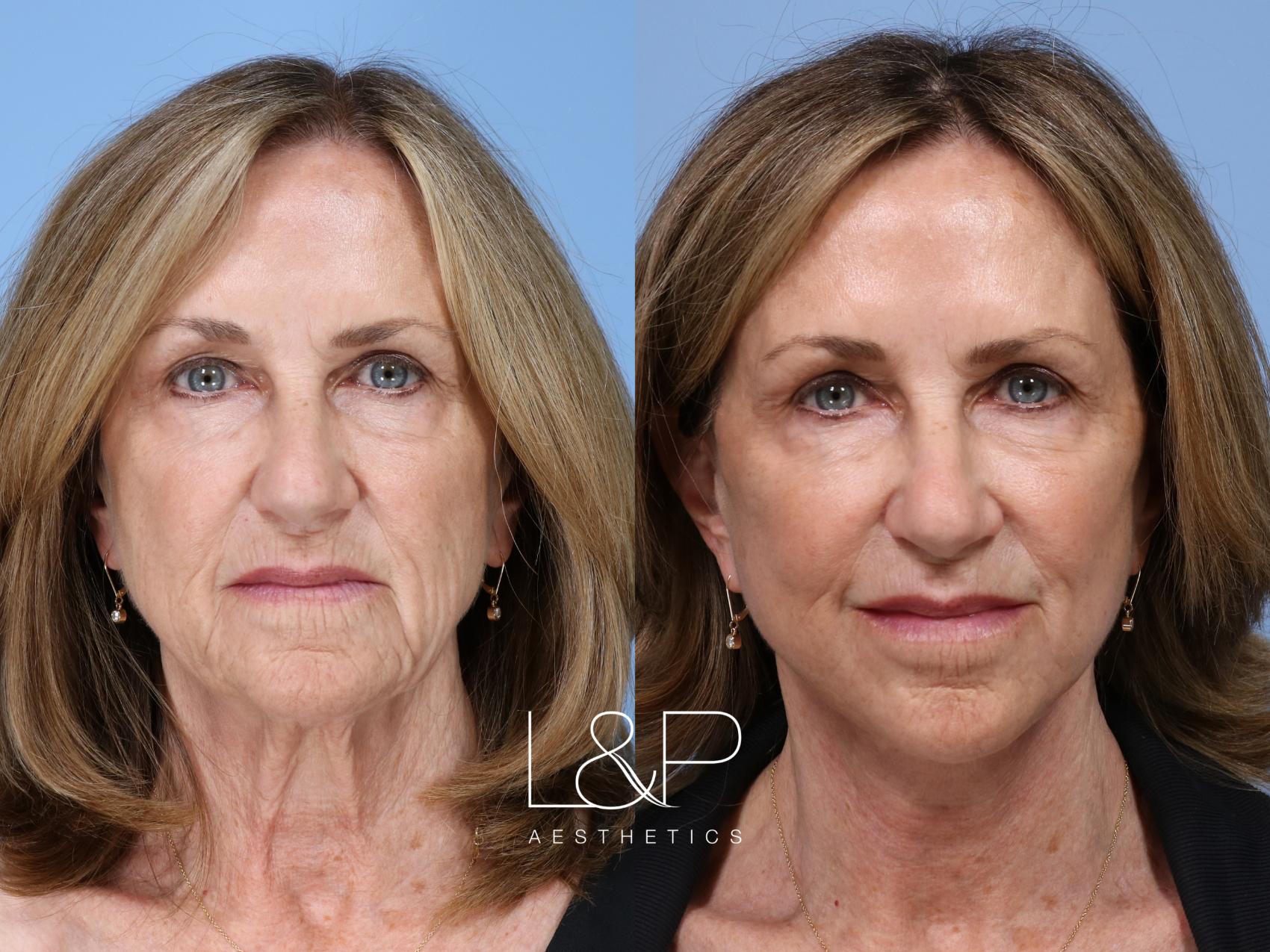 Full Facial Rejuvenation with L&P Signature Facelift