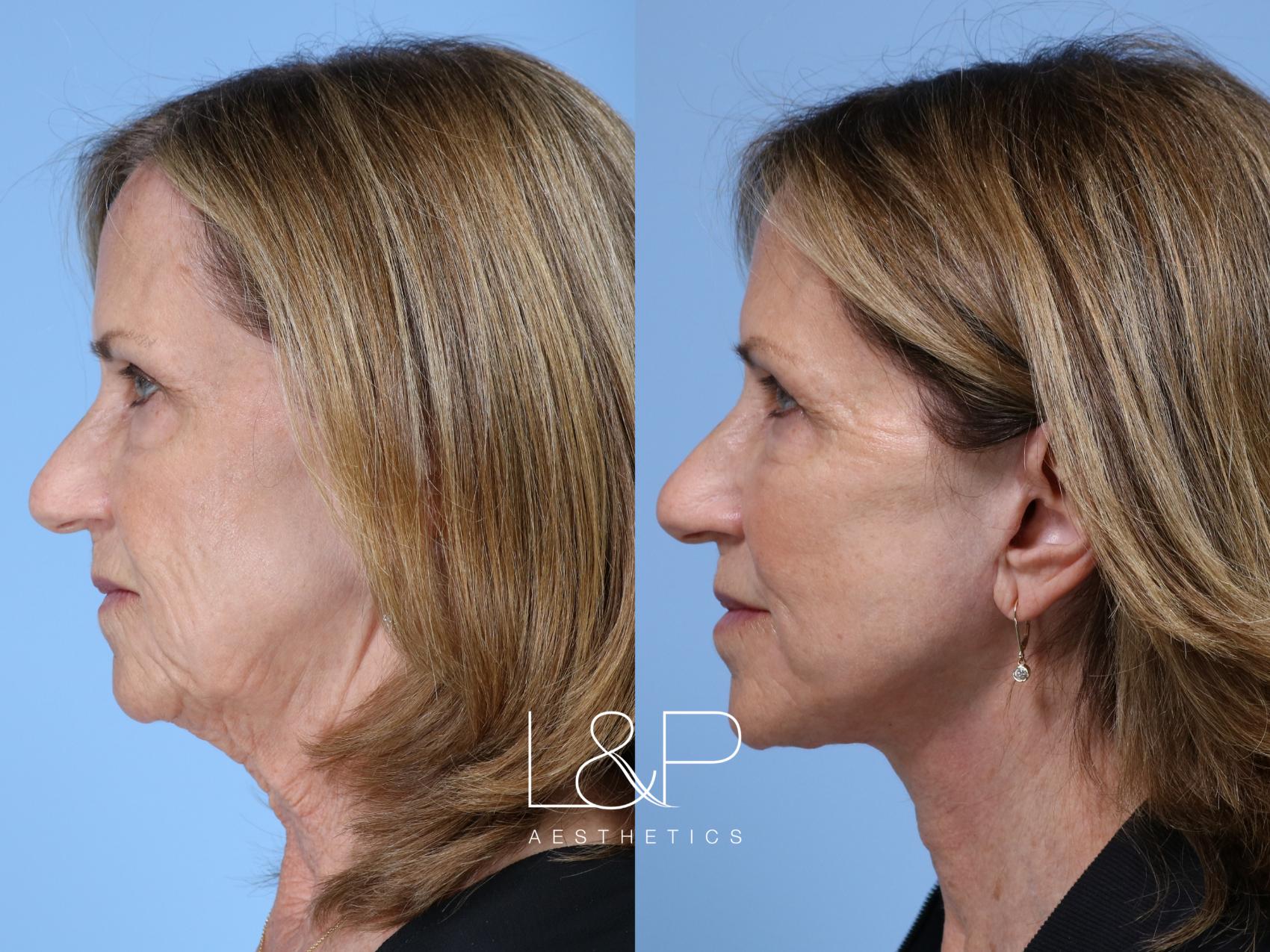 Full Facial Rejuvenation with L&P Signature Facelift