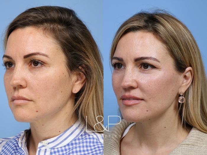 Stunning Facial Rejuvenation for woman in her 40s