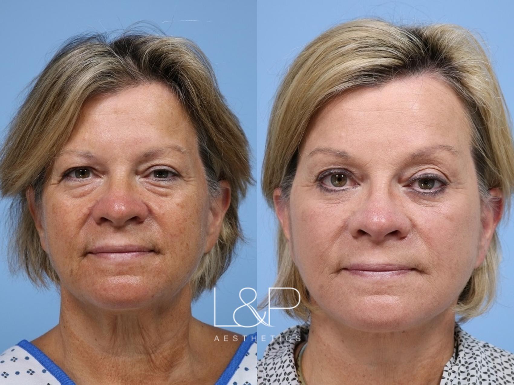 Bay Area woman takes years off her appearance with L&P Signature Facelift