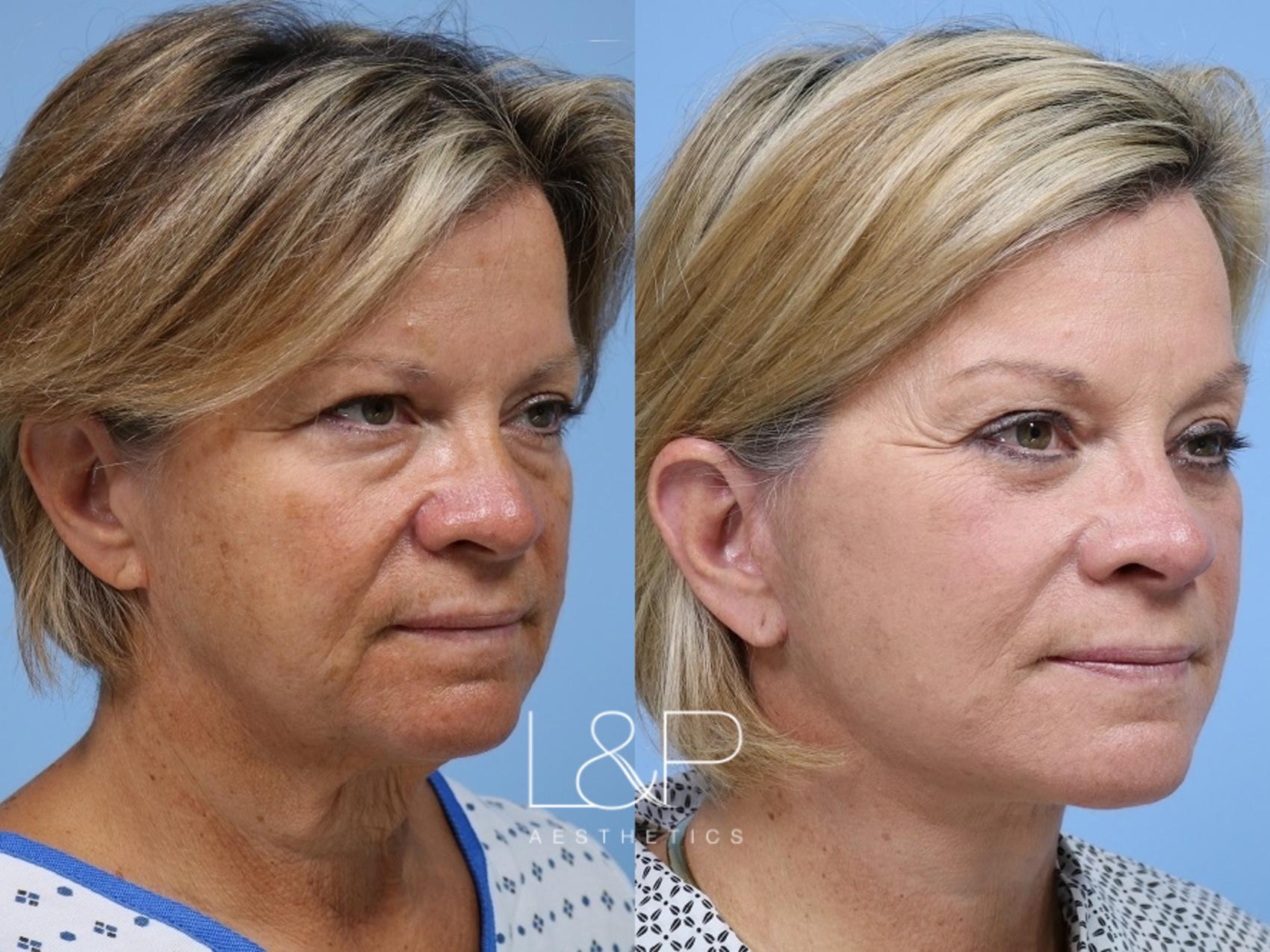 Bay Area woman takes years off her appearance with L&P Signature Facelift