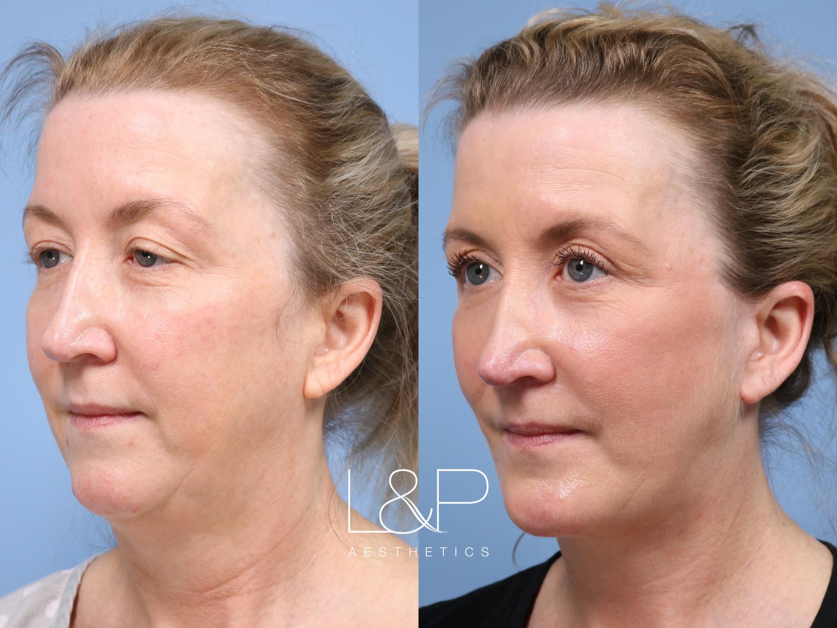 L&P Aesthetics specializes in facial plastic surgery that appears ...