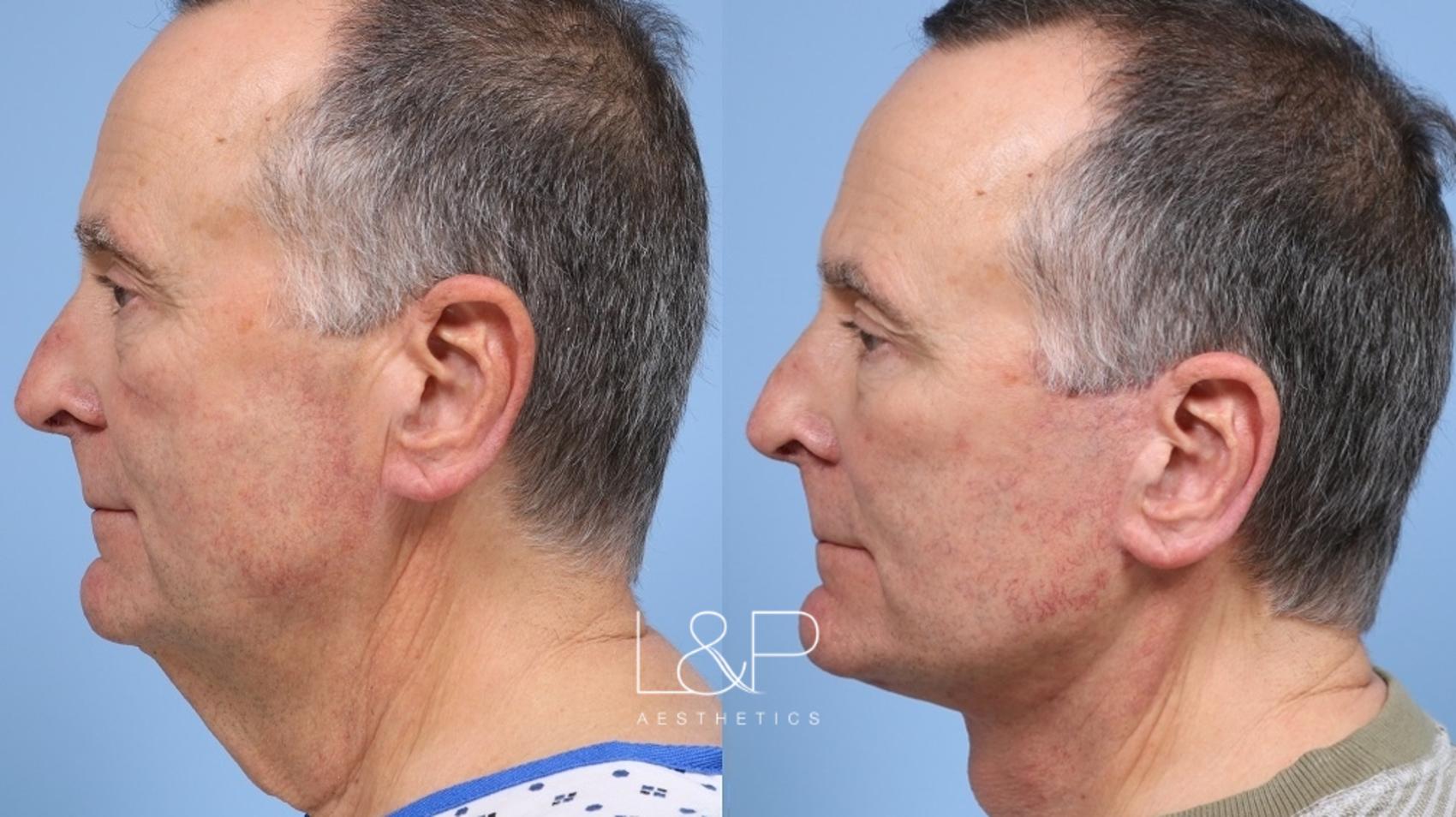 L&P Signature Facelift & Neck Lift with limited fat transfer