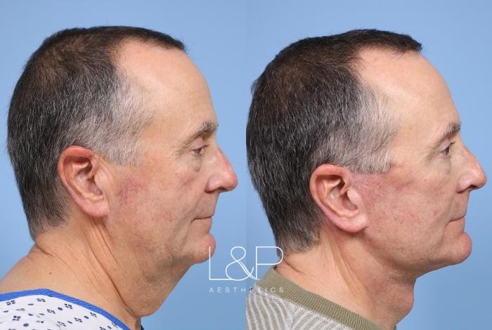 Male L&P Signature Facelift and Neck Lift