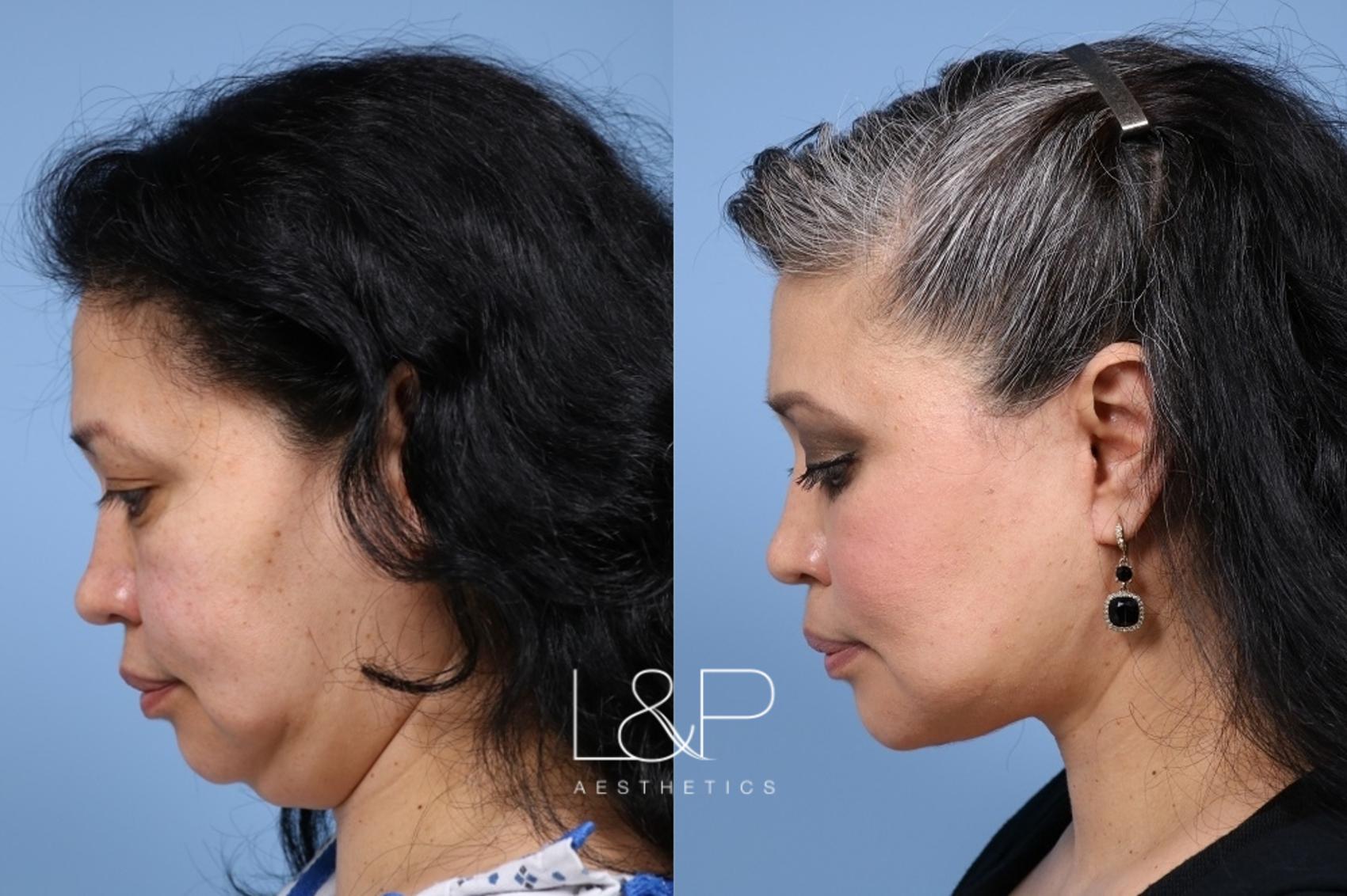 The Female Custom Jawline Implant Design - Explore Plastic Surgery