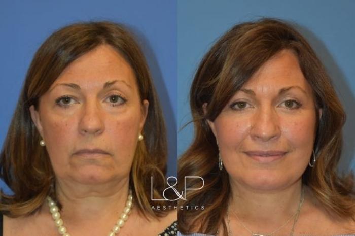 Before & After Facelift & Neck Lift Case 28 Front View in Palo Alto & San Jose, California