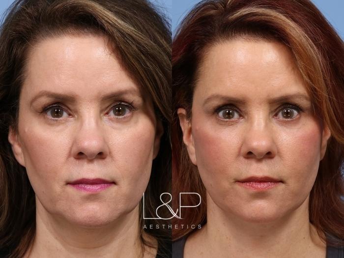 Drs Lieberman And Parikh Of Landp Aesthetics Have Proven To Be The Bay Areas Top Facial Plastic