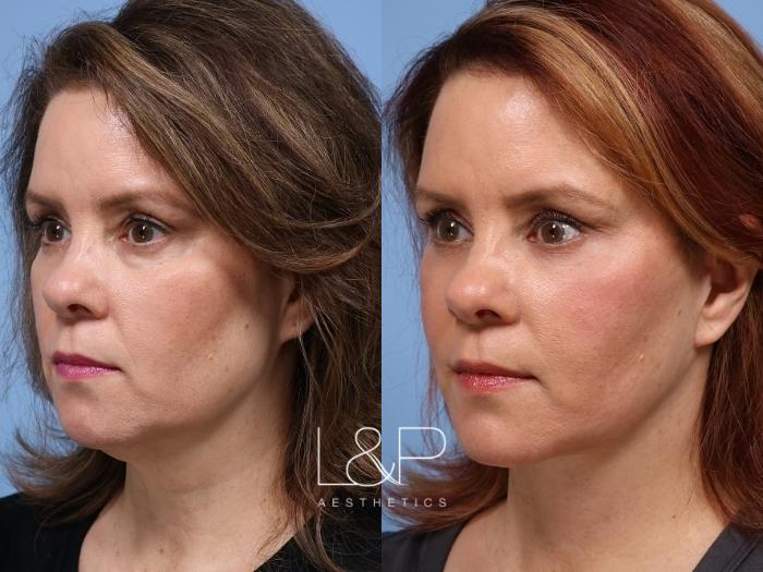 Drs. Lieberman and Parikh of L&P Aesthetics have proven to be the Bay