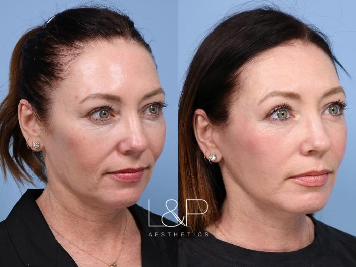 Woman from Pacifico Finally pulls the trigger on Deep Plane Facelift as she approaches 50