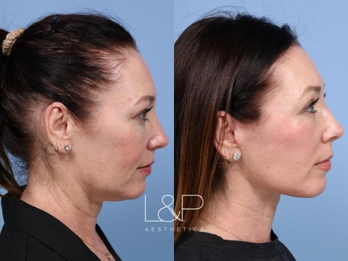 Woman from Pacifico Finally pulls the trigger on Deep Plane Facelift as she approaches 50