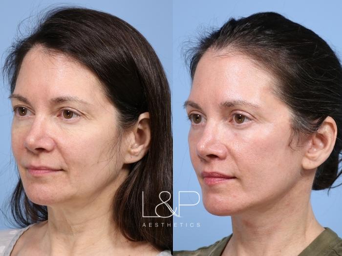 Full facial refresh achieved with deep plane Facelift