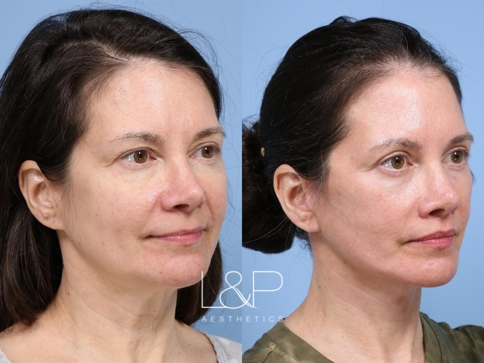 Full facial refresh achieved with deep plane Facelift