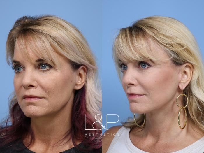 Revision Facelift for Menlo Park Woman