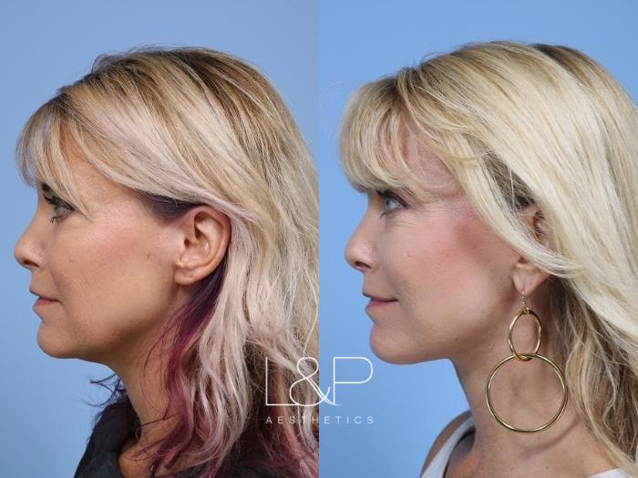 Revision Facelift for Menlo Park Woman