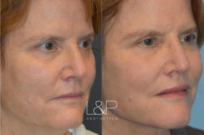 Facelift And Neck Lift Before And After Photos Case 29 Palo Alto And San