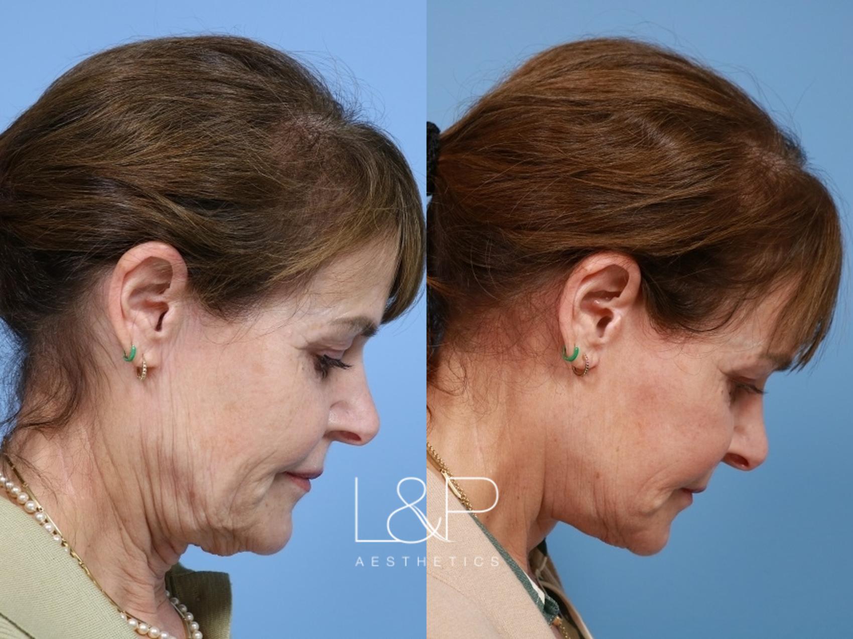 Drs. Lieberman and Parikh specialize in customizing each deep plane