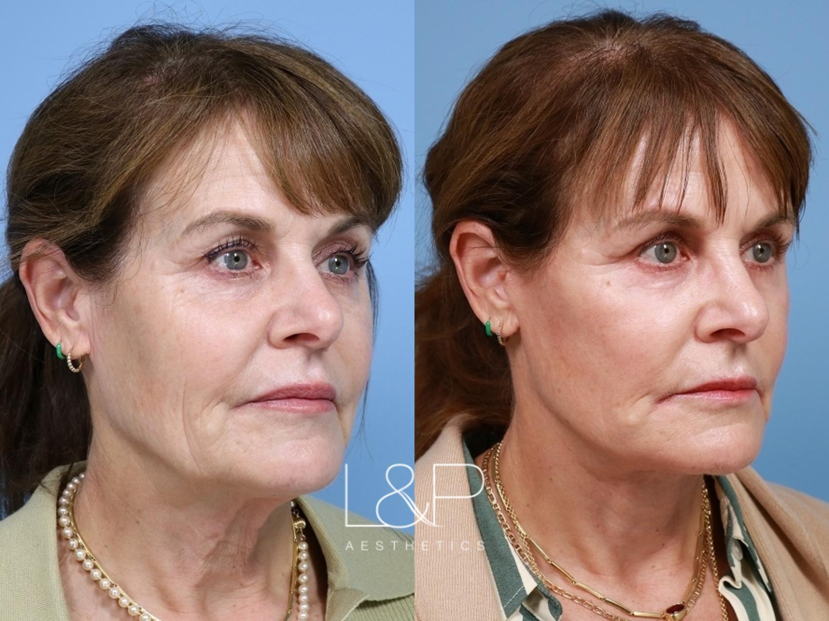 Drs. Lieberman and Parikh specialize in customizing each deep plane