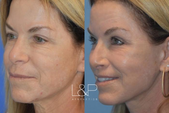 Before & After Facelift & Neck Lift Case 30 Left Oblique View in Palo Alto & San Jose, California