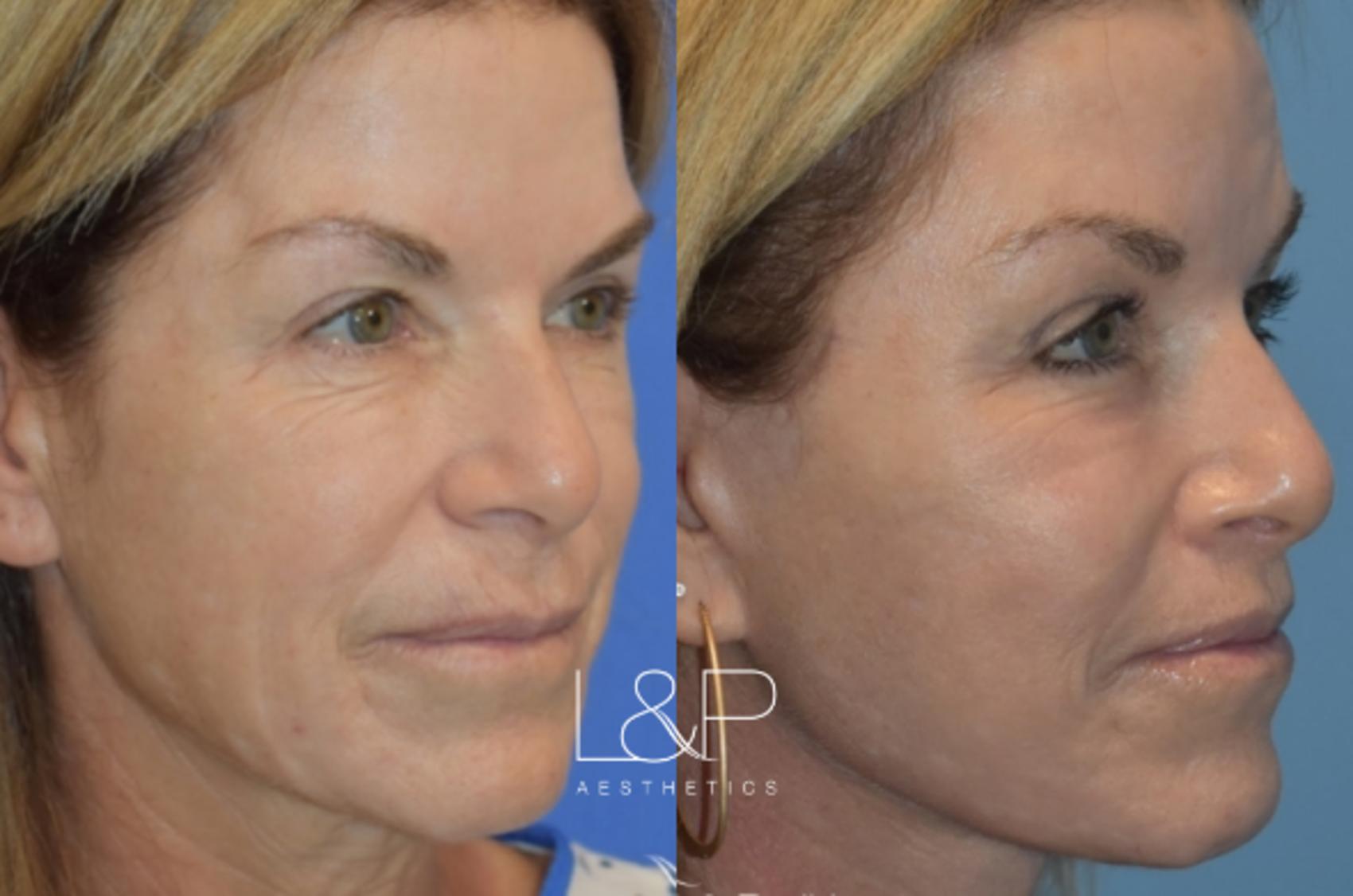 Before & After Facelift & Neck Lift Case 30 Right Oblique View in Palo Alto & San Jose, California