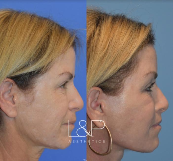 Before & After Facelift & Neck Lift Case 30 Right Side View in Palo Alto & San Jose, California