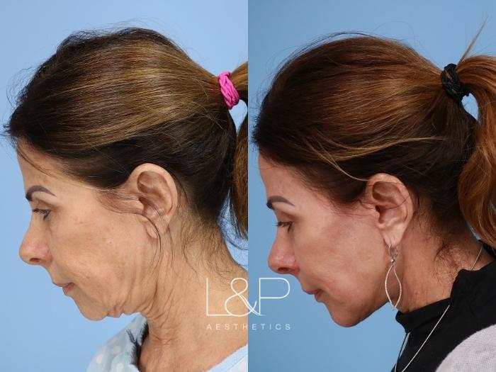 Deep Plane Face and Neck Lift for Anti-Aging