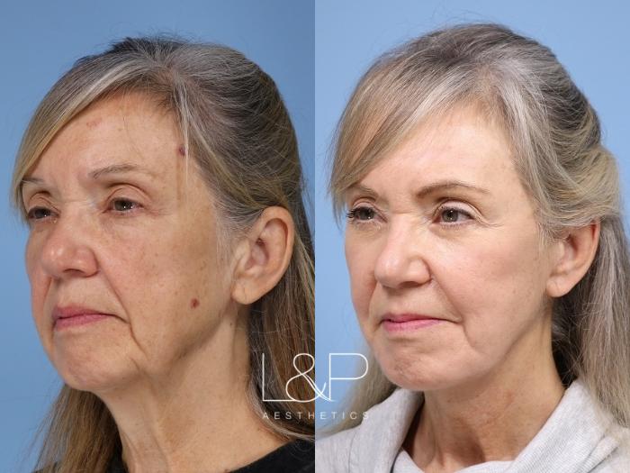 Deep Plane Face and Neck Lift with Compliment Procedures