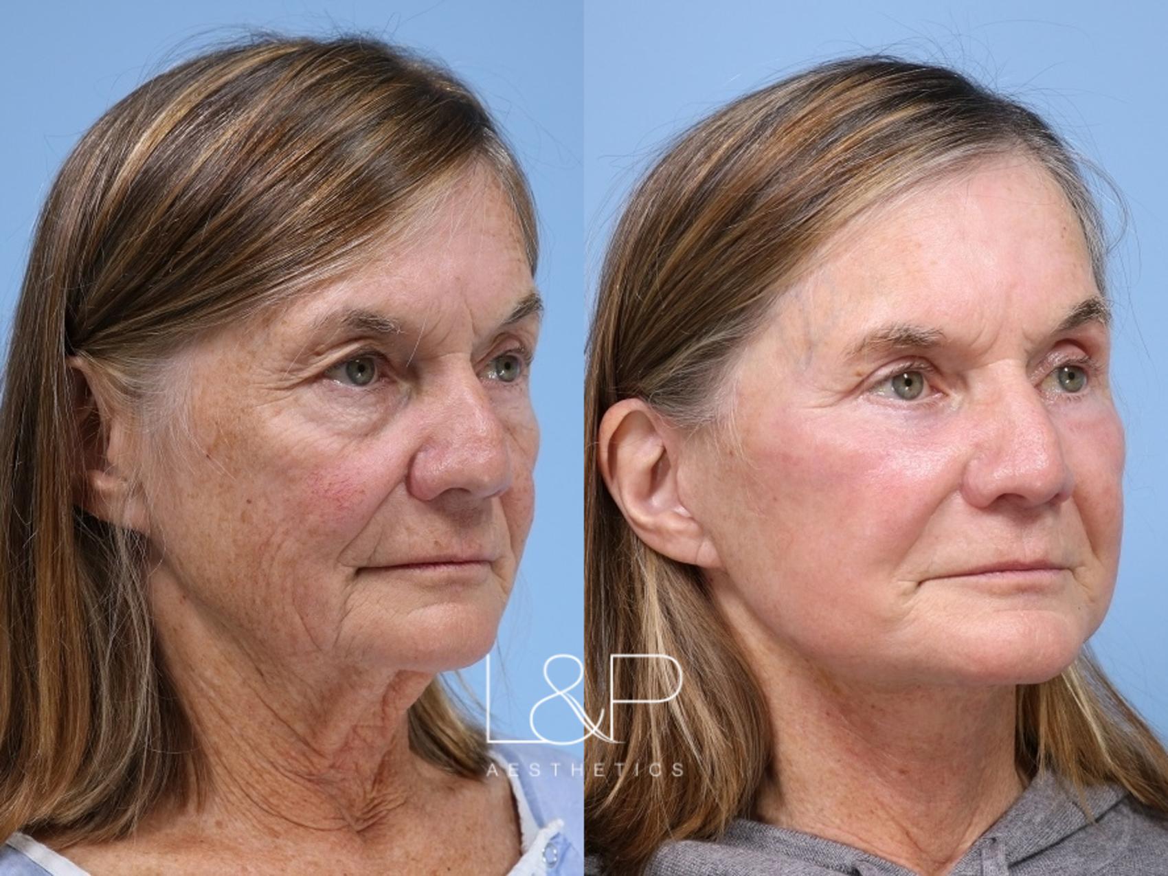 A deep plane facelift requires surgical expertise and an artistic eye