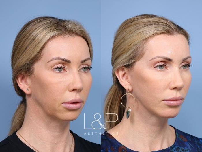 Deep Plane Facelift and Neck Lift for Younger Patient