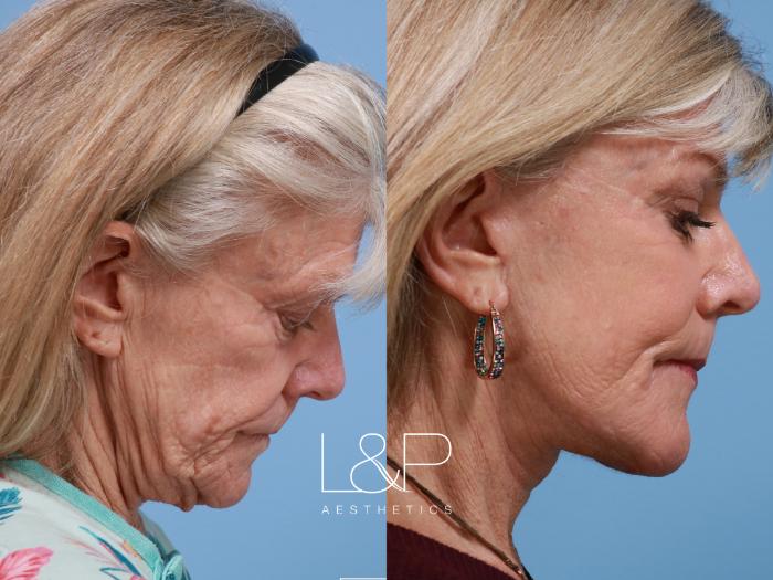 Deep Plane Facelift for Woman in Her 60s