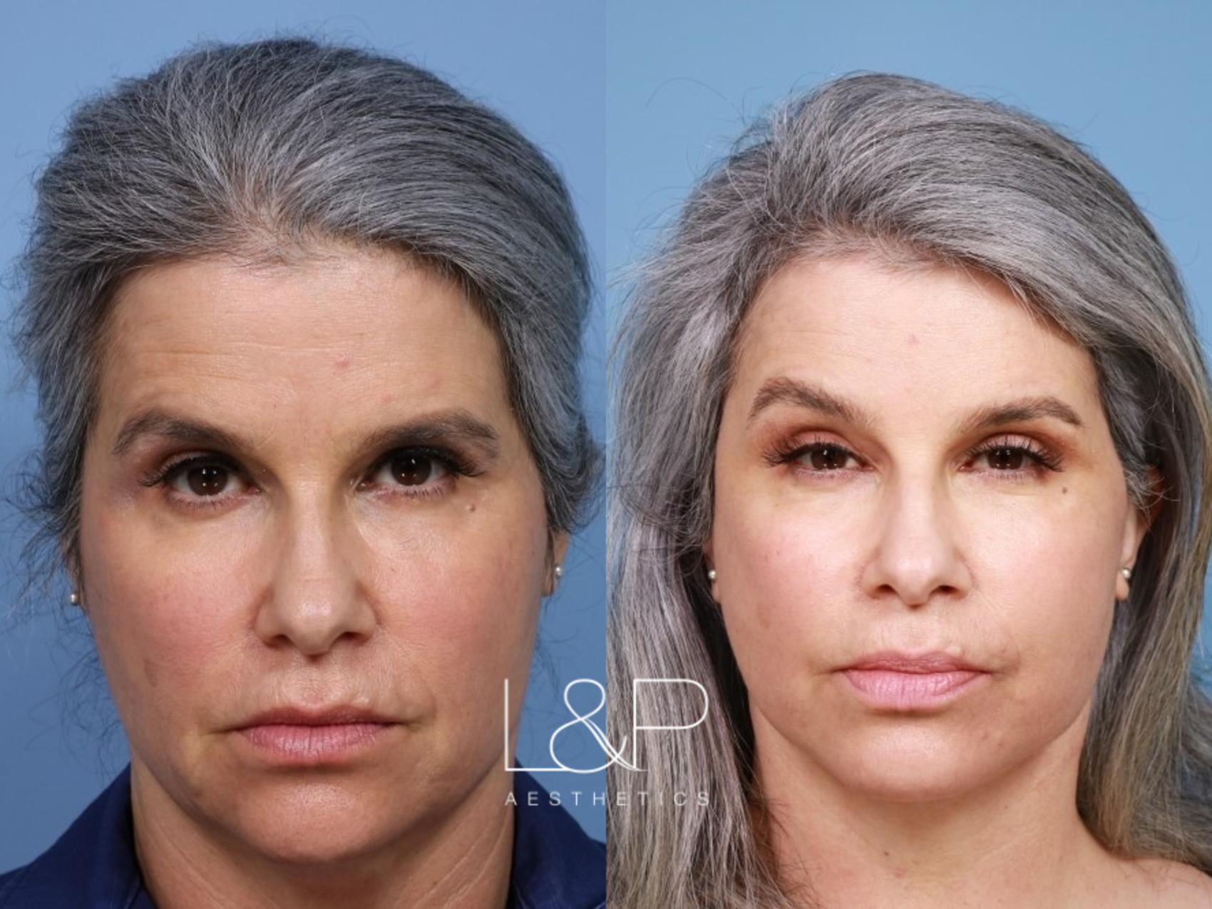 A deep plane facelift and neck lift is the best way to rejuvenate the