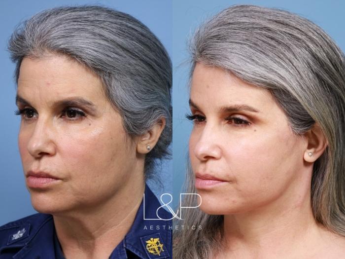 Natural Looking Facial Rejuvenation