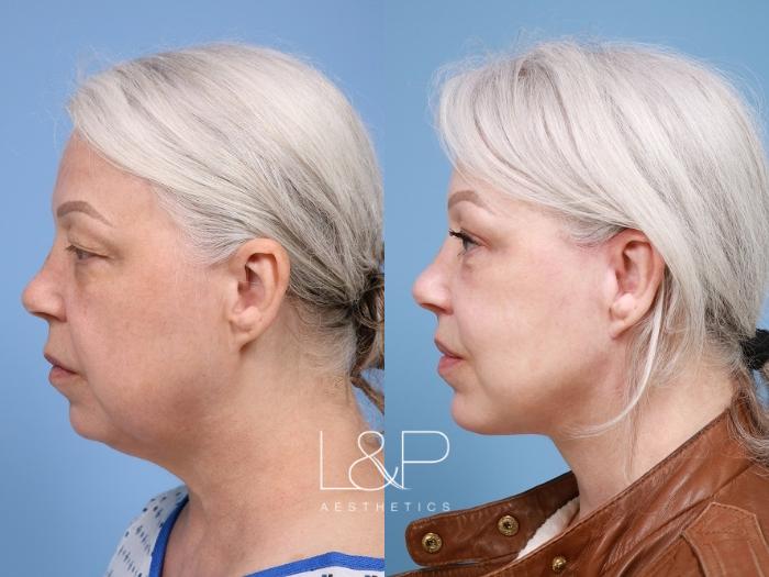 Full Facial Rejuvenation with Individualized Approach