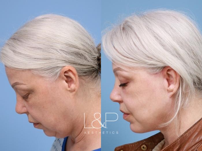 Full Facial Rejuvenation with Individualized Approach