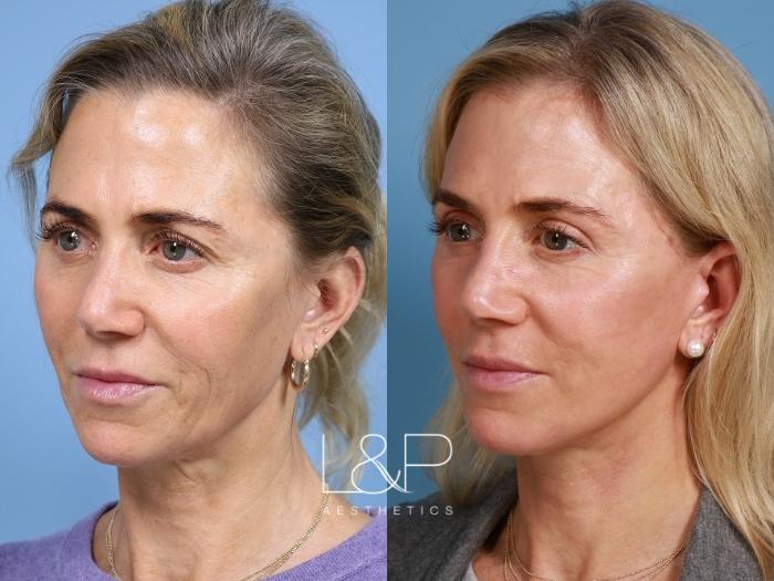 Natural looking facelift and neck lift result