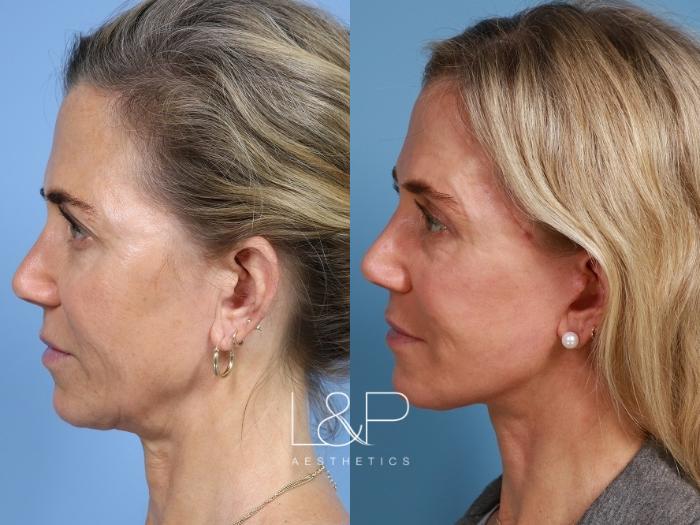 Natural looking facelift and neck lift result