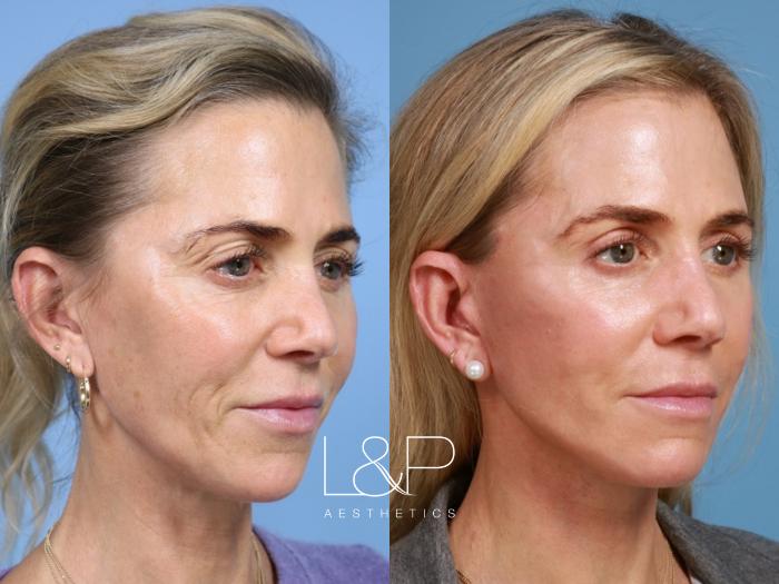 Natural looking facelift and neck lift result