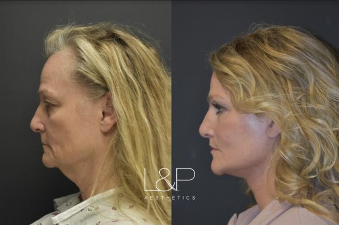 Before & After Facelift & Neck Lift Case 35 Left Side View in Palo Alto & San Jose, California